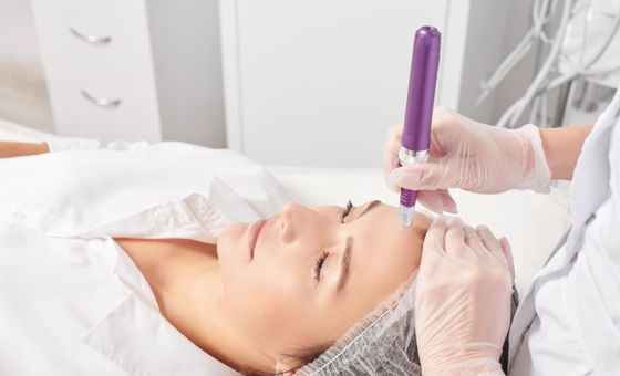 Mujer realizándose el microneedling en centro de estética granada